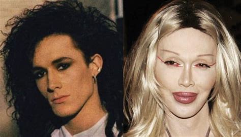 Pete Burns Plastic Surgery Before and After Pictures 2024