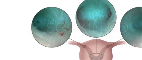 Hysteroscopy: Procedure, Uses, and Recovery Time