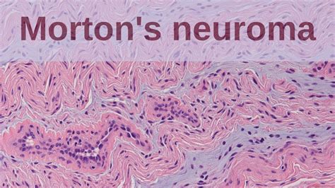 What is a Morton's Neuroma? - Pathology mini tutorial - YouTube