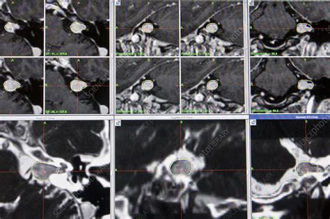 Acoustic neuroma, mri - Stock Image - C006/3803 - Science Photo Library