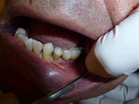 implant, dentistry, dentist, teeth, surgery, human body part, close-up, body part, human lips ...