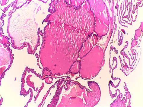 Thyroglossal Duct Cyst Histology