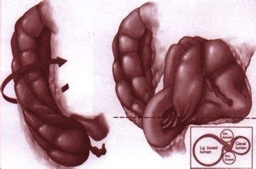 Cecal volvulus is due to the cecum twisting around the ascending colon ...