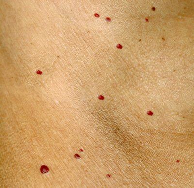 What Those Tiny Red Dots on Your Skin Might Mean » Scary Symptoms