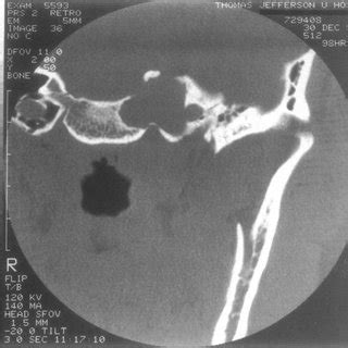 Coronal CT scan shows mass in left petrous apex. Note dehiscent carotid ...