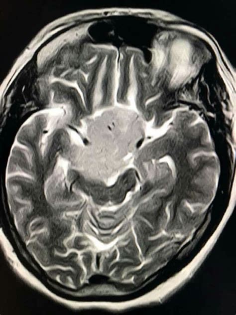 Gliosis Mri - IMobile Cool