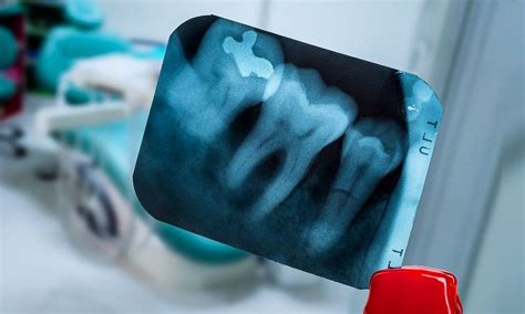 DENTAL RADIOLOGY : How to Take Periapical Radiographs - Directorio ...