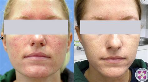 Laser Treatment for Rosacea - Richmond Hill Cosmetic Clinic