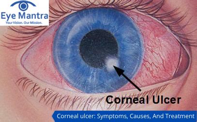 कॉर्नियल अल्सर (Corneal Ulcer): लक्षण, कारण और उपचार