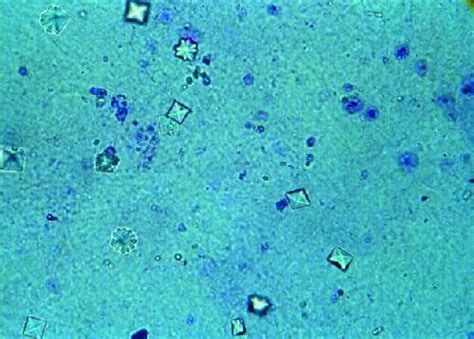 File:Calcium oxalate crystals in urine.jpg - Wikipedia