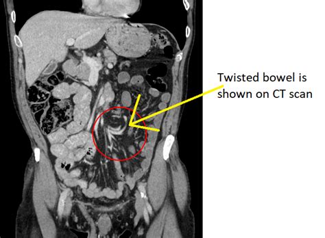 Volvulus CT - wikidoc