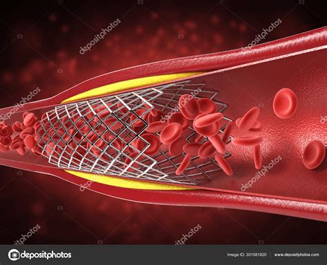 Balloon angioplasty procedure Stock Photo by ©phonlamai 301581820