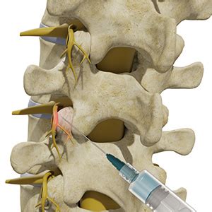 Facet Injection Houston | Back Injury Pearland | Spinal Arthritis Kingwood