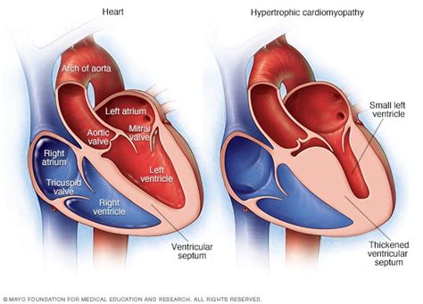 Hypertrophic cardiomyopathy - Symptoms and causes - Mayo Clinic