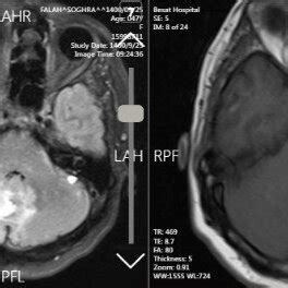 Brain MRI revealed a ventriculoperitoneal shunt, evidence of previous... | Download Scientific ...