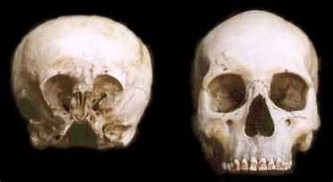 Starchild Project Confirms Skull As Alien | Deformed human skull ...