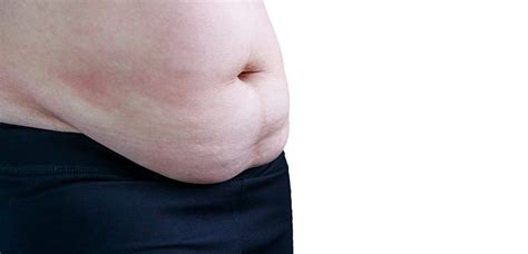 Panniculectomy Surgery | Post-Bariatric Body Contouring