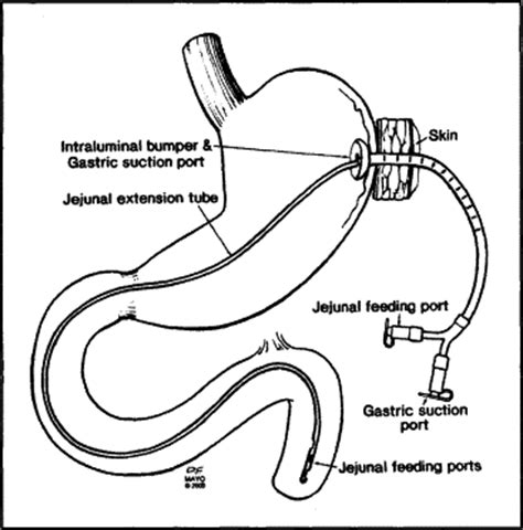 The Tribulation of a Coiled Tube Change