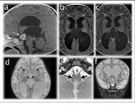 Figure 1 from Alexander disease | Semantic Scholar