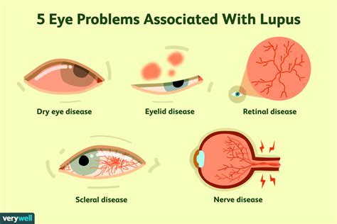 5 Ways Lupus Affects the Eyes