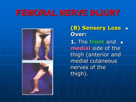 PPT - FEMORAL NERVE INJURY PowerPoint Presentation - ID:472761