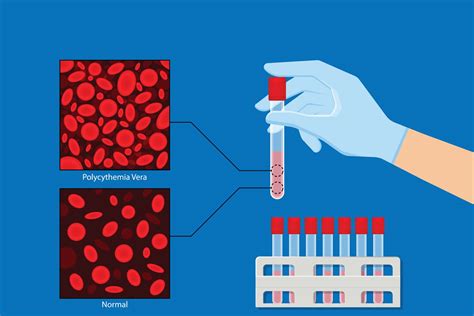 What Is Polycythemia Vera?