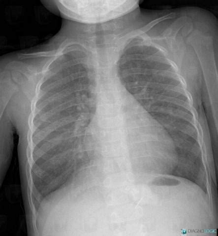 Radiology case : Hyaline membrane disease (X rays ,CT) - Diagnologic