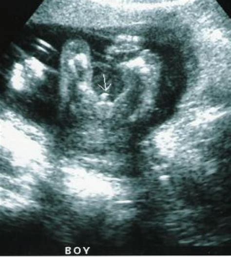 Boy or Girl Ultrasound | New Health Advisor