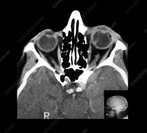 CT of Choroidal Detachment - Stock Image - M155/0572 - Science Photo Library