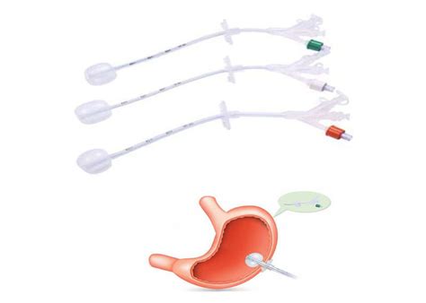 Silicone Gastrostomy Feeding Tubes endoscopic surgery gastrostomy tube