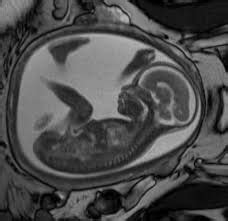 Fetal MRI