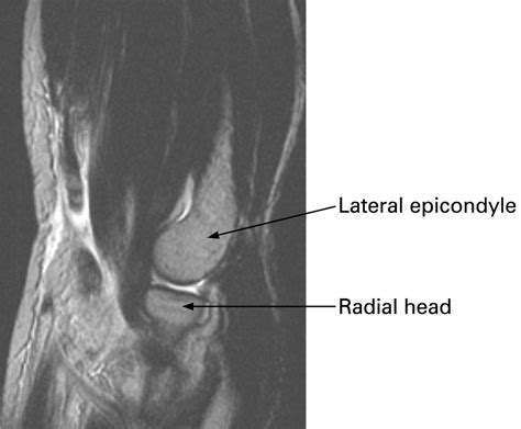 A 61-year-old man with pain in antecubital fossa after an elbow hyperextension injury ...