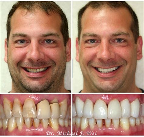 Smile Makeover Cosmetic Dentist by Dr. Michael J. Wei, DDS - Manhattan NYC - Michael J. Wei DDS PC