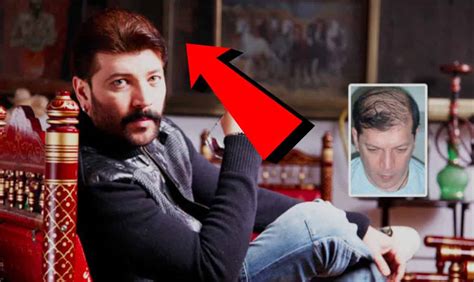 Bollywood Actors Hair Transplant Before and After Images - TrendingWeBlog