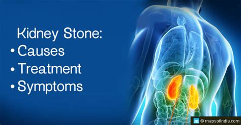 Kidney Stone: Causes, Symptoms and Treatment | My India