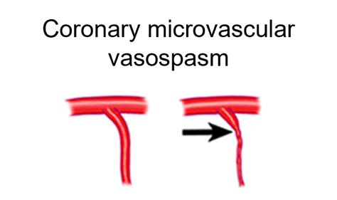 Coronary vascular dysfunction - ECG-Excellence