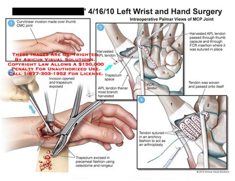 AMICUS Illustration of amicus,surgery,wrist,hand,thumb,CMC,joint ...