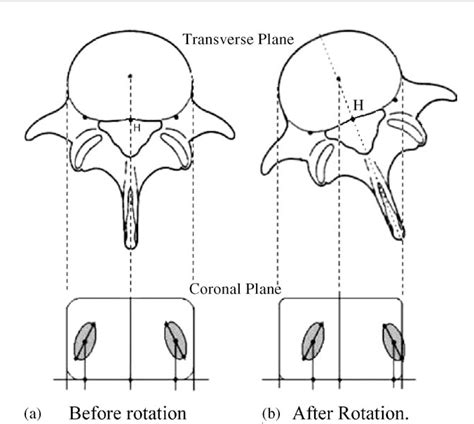 Figure 1 from Vertebral axial rotation measurement method | Semantic Scholar