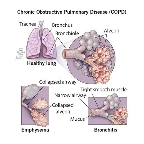 COPD: Causes, Symptoms, Diagnosis, Treatment & Prevention (2022)