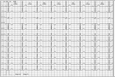 Alternating P Wave Morphology | Circulation