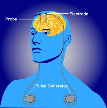 Deep Brain Stimulation - Physiopedia