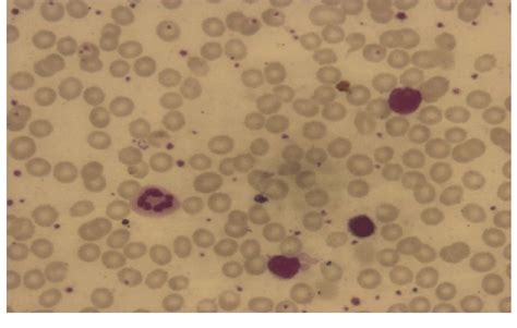 Peripheral blood smear showing normocytic normochromic anemia with no ...