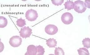 Echinocytes And Crenation