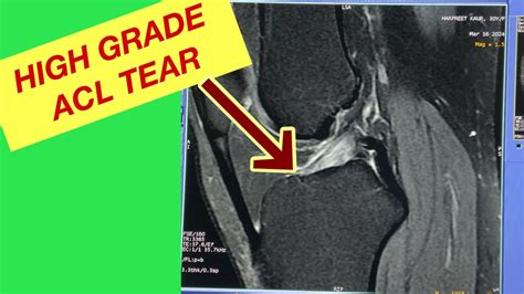 MRI knee high gradeACL Tear.#ACL tear #Ligament tear MRI knee #Acl tear diagnose - YouTube
