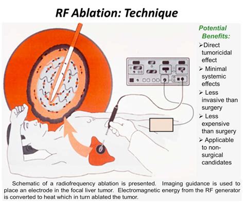 EXAMS AND ME : Radiofrequency Ablation