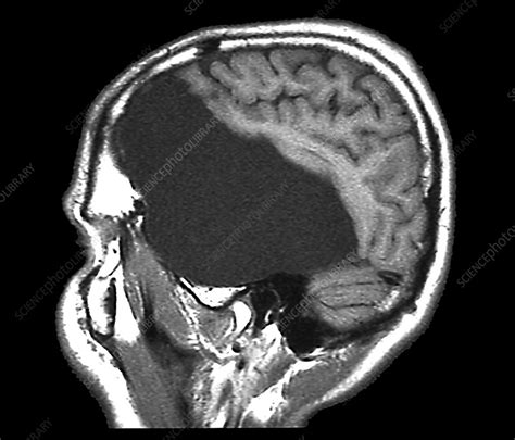 Large arachnoid cyst, MRI scan - Stock Image - C047/4269 - Science ...