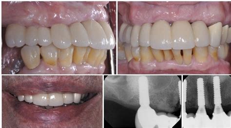 Full Arch Options “All on Four” – Dental Implants & Periodontics of CT