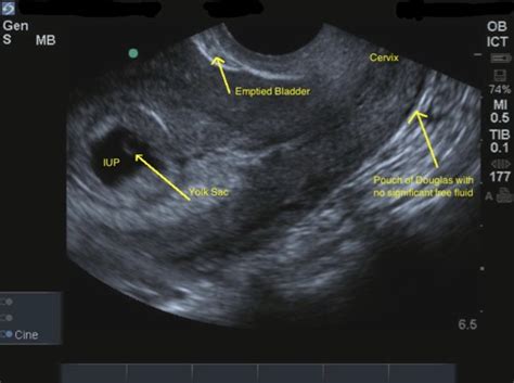 Monet forudsigelse buste vaginal ultrasound scan Selv tak Shinkan pris