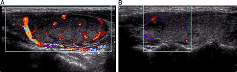 Ultrasound of primary thyroid non-Hodgkin's lymphoma - Clinical Imaging