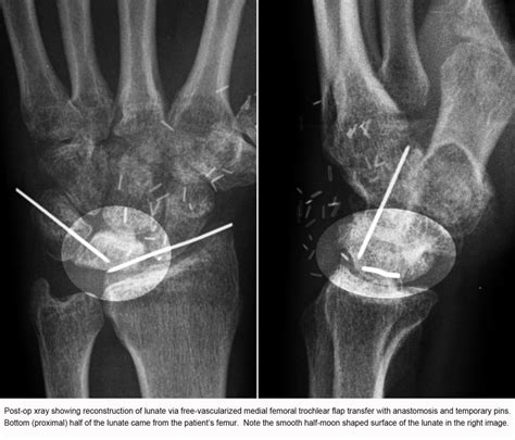 Avascular Necrosis of the Lunate (Kienbock’s Disease)